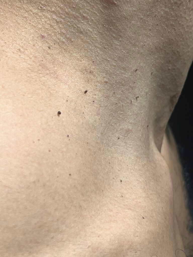 skin tag removal k-clinic